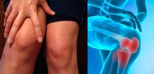 Discomfort and swelling in the knee area are the first symptoms of osteoarthritis. 